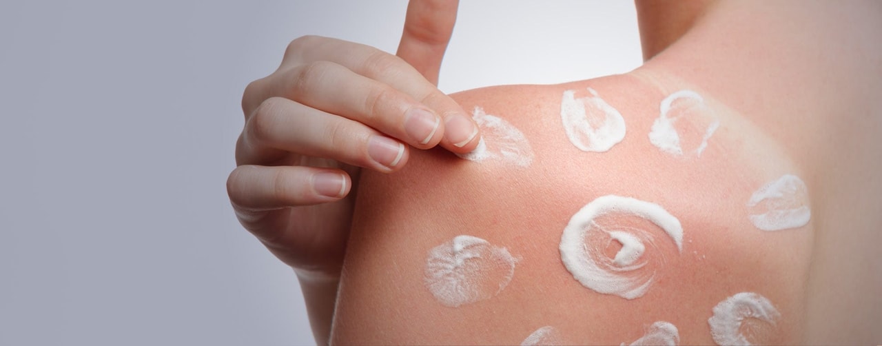 Treatment for sun damage and age spots