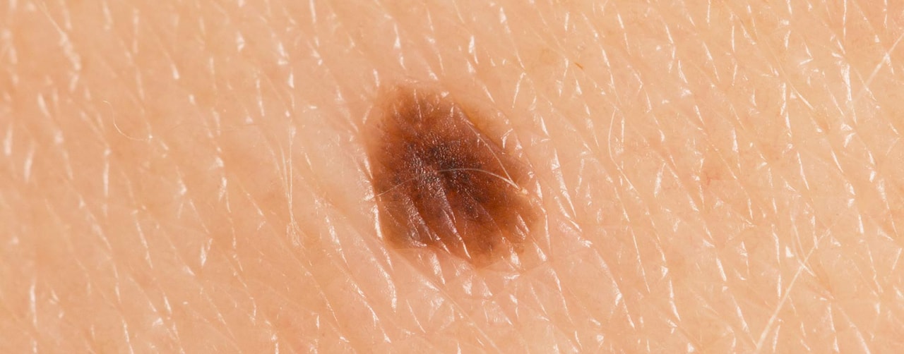 Skin cancer and lesion assessment