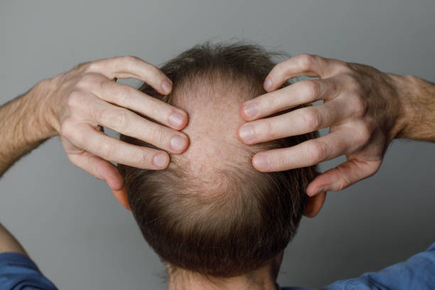 Treatment for hair loss